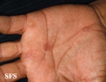 syphilis secondary