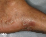 syphilis secondary