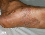 syphilis secondary