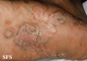 syphilis secondary