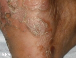 syphilis secondary