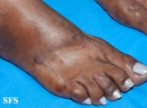 syphilis secondary