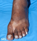 syphilis secondary
