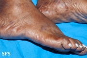 syphilis secondary
