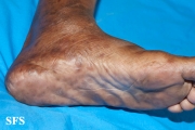 syphilis secondary