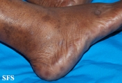 syphilis secondary