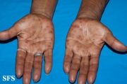 syphilis secondary