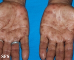 syphilis secondary