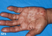 syphilis secondary