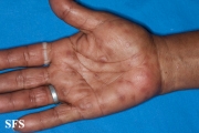 syphilis secondary