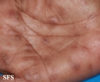 syphilis secondary