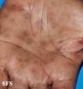 syphilis secondary