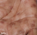 syphilis secondary