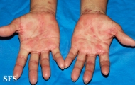 syphilis secondary