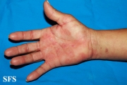 syphilis secondary