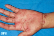 syphilis secondary