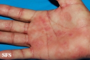 syphilis secondary