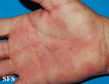 syphilis secondary