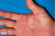 syphilis secondary