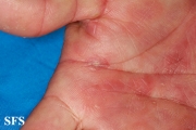 syphilis secondary