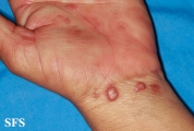 syphilis secondary