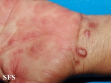 syphilis secondary