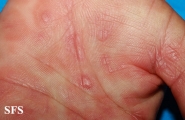syphilis secondary