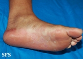 syphilis secondary