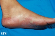 syphilis secondary