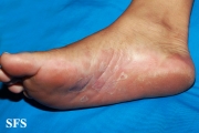 syphilis secondary