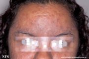 syphilis secondary