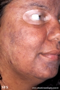 syphilis secondary