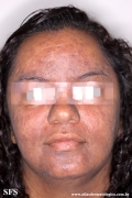 syphilis secondary