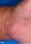 syphilis secondary