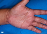 syphilis secondary