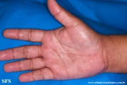 syphilis secondary