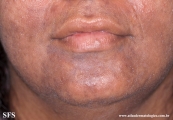 syphilis secondary