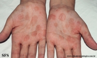 syphilis secondary