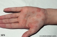 syphilis secondary