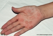 syphilis secondary