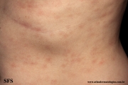 syphilis secondary