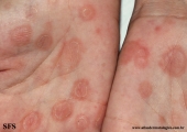 syphilis secondary