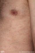 syphilis secondary