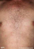 syphilis secondary