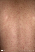 syphilis secondary