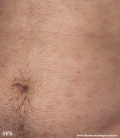 syphilis secondary