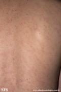 syphilis secondary