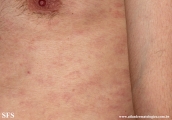 syphilis secondary