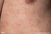 syphilis secondary