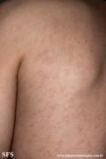 syphilis secondary